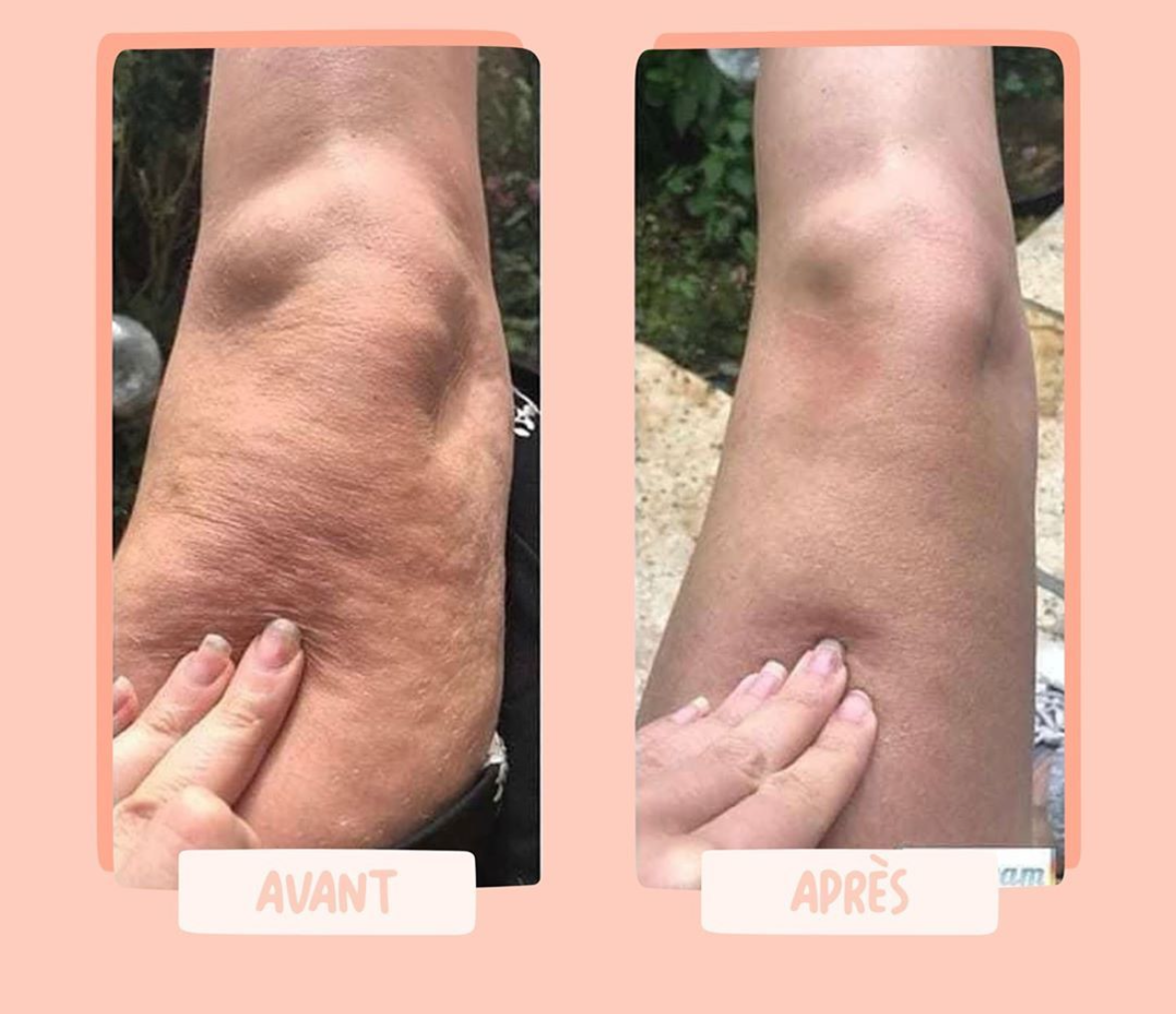 Appareil Sculptant Corps 2025 – Anti-Cellulite & Remodelage avec Succion Réglable